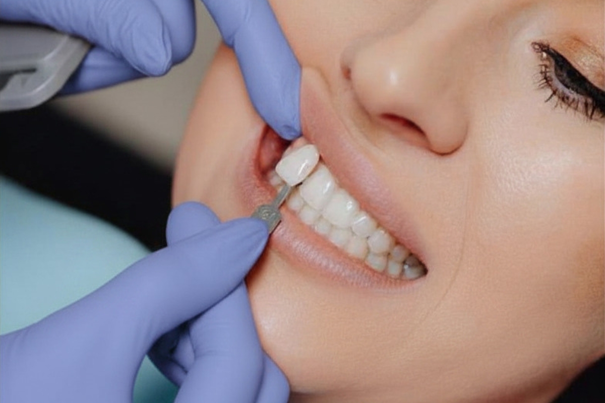 HRD_Composite Bonding (1200 x 800)
