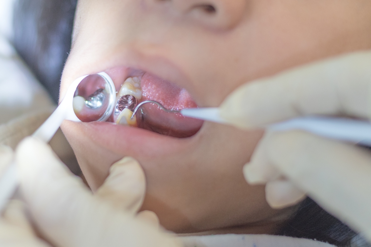 HRD_Fillings (1200 x 800)