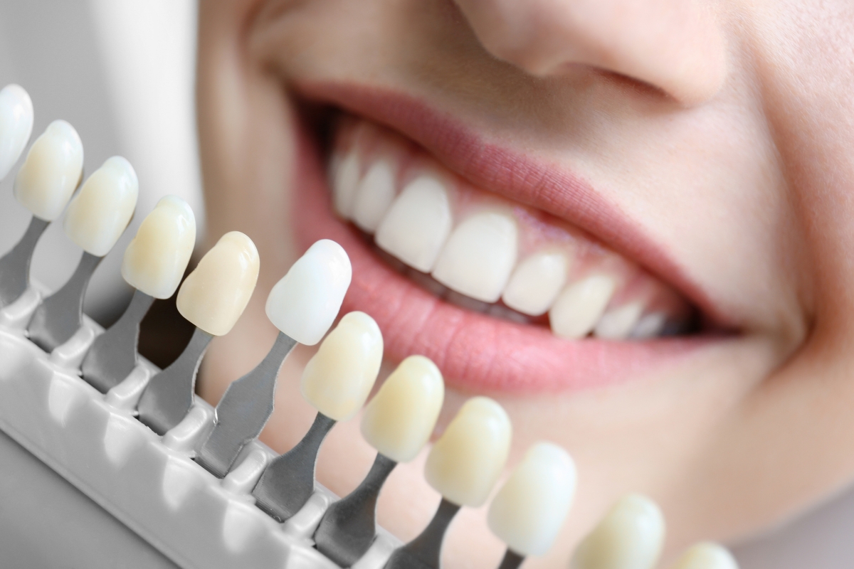 HRD_Teeth Whitening (1200 x 800)