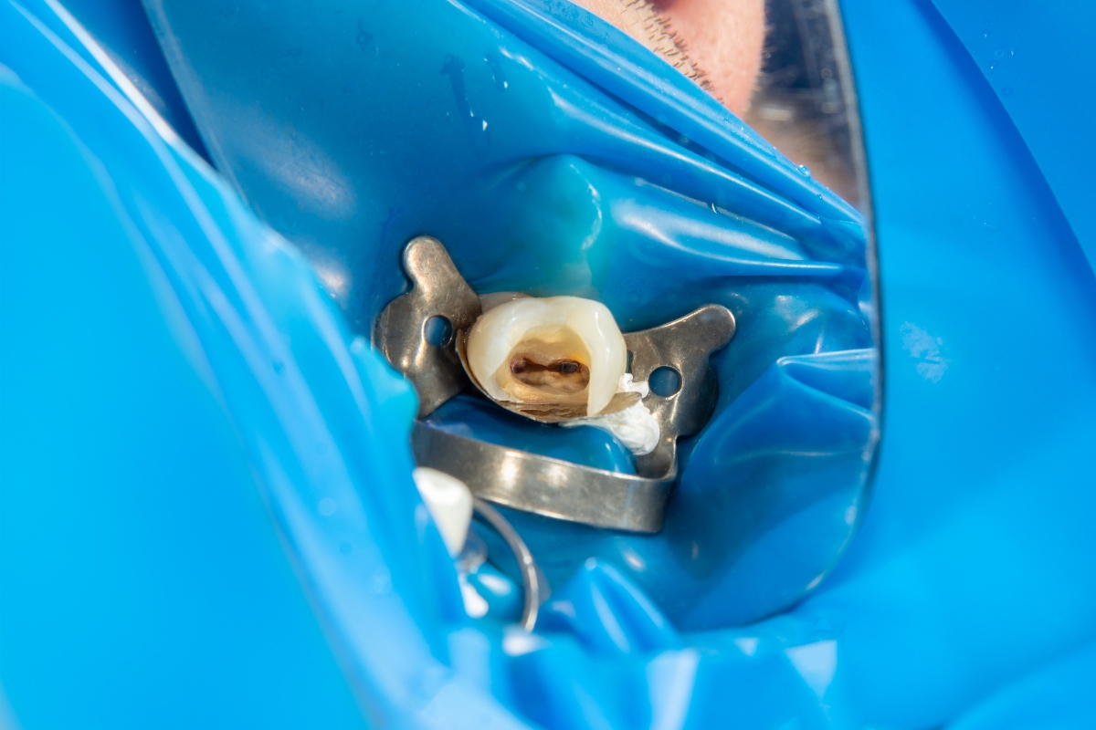 HRD_Root Canal (1200 x 800)2